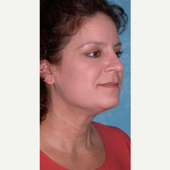52 year old female Rhinoplasty after 3732538