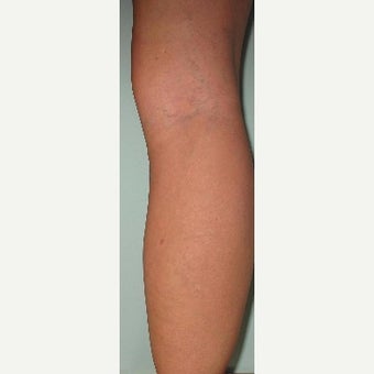 45-54 year old woman treated with EVLT after 2533531