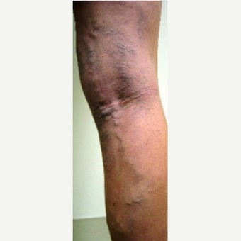 45-54 year old woman treated with EVLT before 2533531