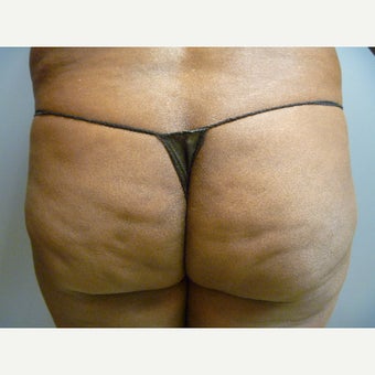 45-54 year old woman treated with Brazilian Butt Lift before 1603871