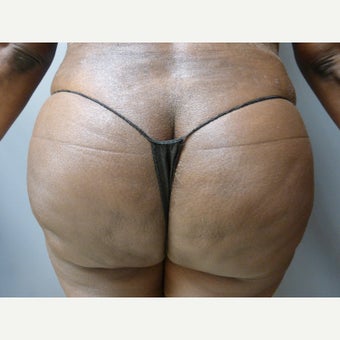 45-54 year old woman treated with Brazilian Butt Lift after 1603871