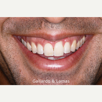 25-34 year old man treated with Gum Lift before 3075243