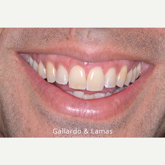 25-34 year old man treated with Gum Lift after 3075243