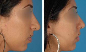 Revision Rhinoplasty before 1208282