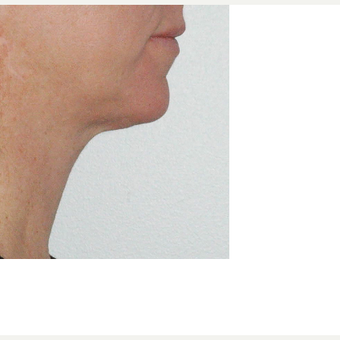 35-44 year old woman treated with Kybella after 3541866