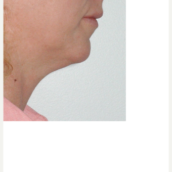 35-44 year old woman treated with Kybella before 3541866