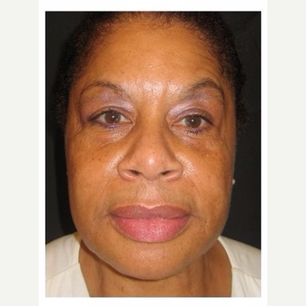 55-64 year old woman treated with Non Surgical Face Lift after 3181099