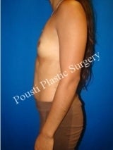 Breast Implant Removal 1094587