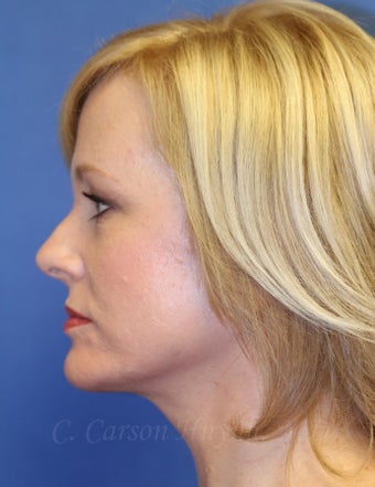 Middle age woman treated with Perma-Lift Facelift and necklift. 777543