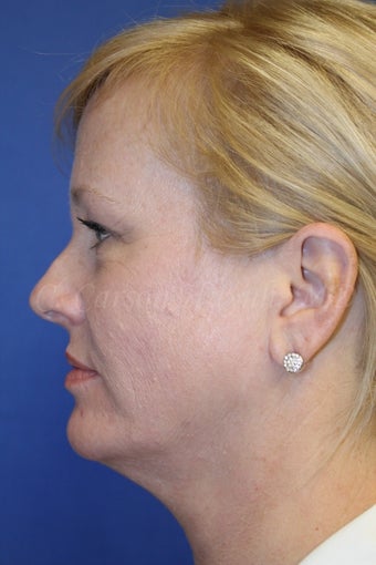 Middle age woman treated with Perma-Lift Facelift and necklift. 777543