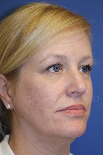 Middle age woman treated with Perma-Lift Facelift and necklift. before 777543