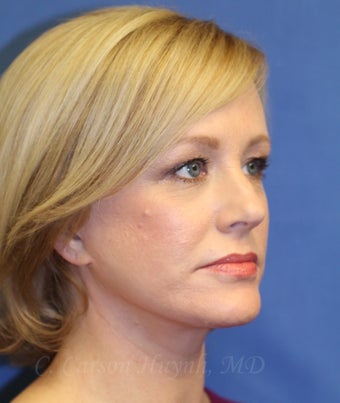 Middle age woman treated with Perma-Lift Facelift and necklift. after 777543