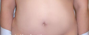 Panniculectomy on 31 Year Old Female after 1101047