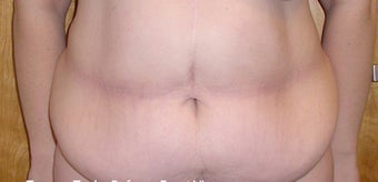 Panniculectomy on 31 Year Old Female before 1101047