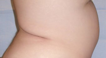 Panniculectomy on 31 Year Old Female 1101047
