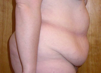 Panniculectomy on 31 Year Old Female 1101047