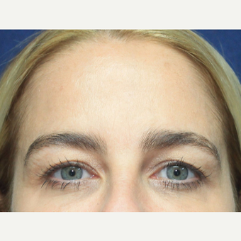 35-44 year old woman treated with Botox after 3520265