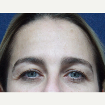 35-44 year old woman treated with Botox before 3520265