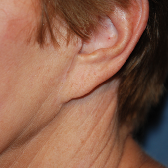 65-74 year old woman treated with Ear Lobe Surgery before 2994914