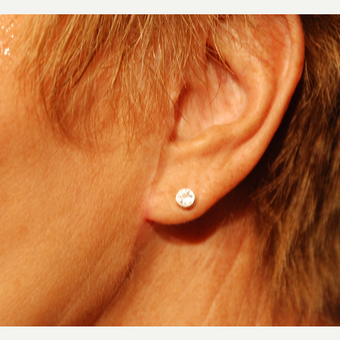 65-74 year old woman treated with Ear Lobe Surgery after 2994914