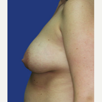 25-34 year old woman treated with Breast Lift with Implants before 3520078