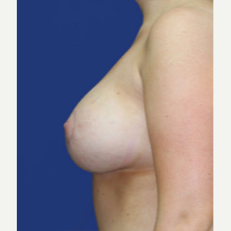 25-34 year old woman treated with Breast Lift with Implants after 3520078