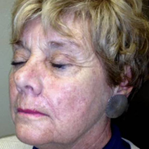 Mohs Surgery after 3711254