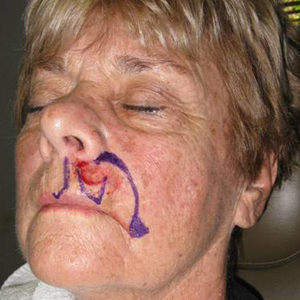 Mohs Surgery before 3711254