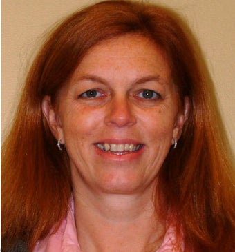 45 year old female open bite, treatment with orthognathic surgery and braces before 933092