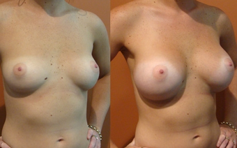 Breast Implants before 975843