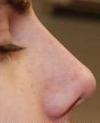 Non-Surgical Rhinoplasty after 93773