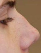 Non-Surgical Rhinoplasty before 93773