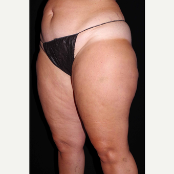 45-54 year old woman treated with Cellulaze after 3280728