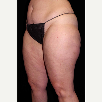 45-54 year old woman treated with Cellulaze before 3280728