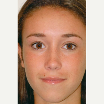 18-24 year old woman treated with Rhinoplasty after 3406223
