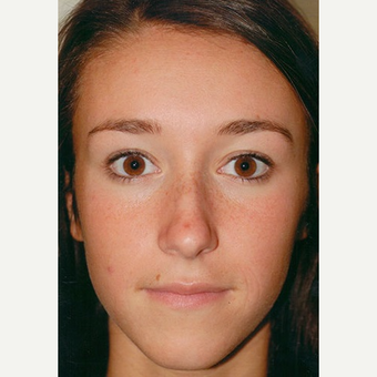 18-24 year old woman treated with Rhinoplasty before 3406223