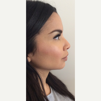Voluma Non Surgical Nose Job™ before 3042493