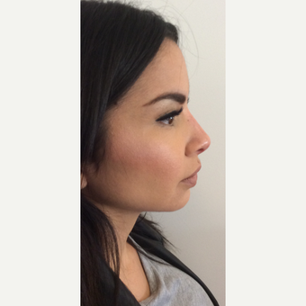 Voluma Non Surgical Nose Job™ after 3042493