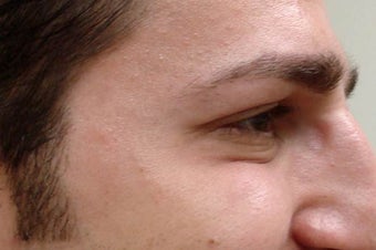 Botox after 989193