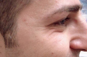 Botox before 989193