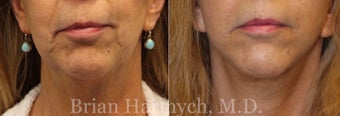 63 year-old female before and 6 months after Facelift and Fat Transfer (Fat Transplantation) before 3446172