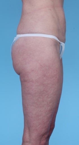 57 Year Old Female treated with Liposuction after 1069131