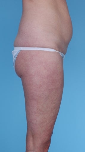 57 Year Old Female treated with Liposuction before 1069131