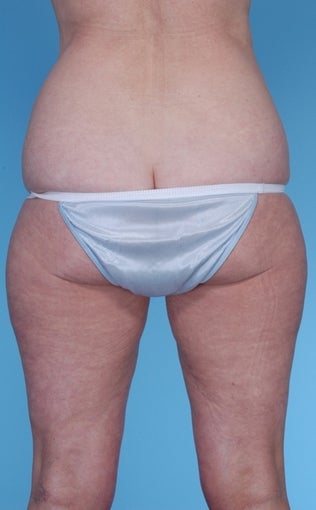 57 Year Old Female treated with Liposuction 1069131