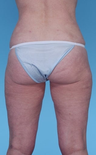 57 Year Old Female treated with Liposuction 1069131