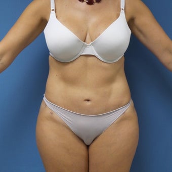 35-44 year old woman treated with Tummy Tuck Revision after 2144371