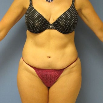 35-44 year old woman treated with Tummy Tuck Revision before 2144371
