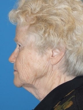 Lower Facelift and Necklift with Platysmaplasty before 241266