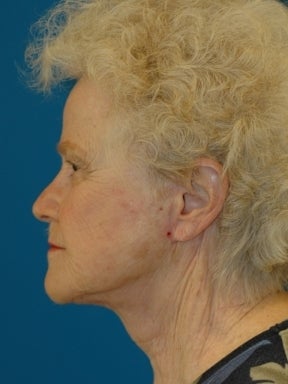 Lower Facelift and Necklift with Platysmaplasty after 241266