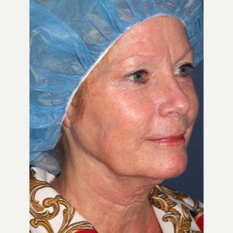 58 year old woman treated with Laser Resurfacing 1942827
